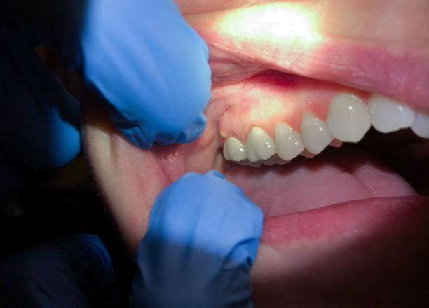 Best Emergency Dental Services for Seniors in Lake Forest, CA